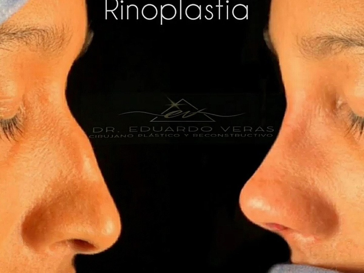 Rinoplastia